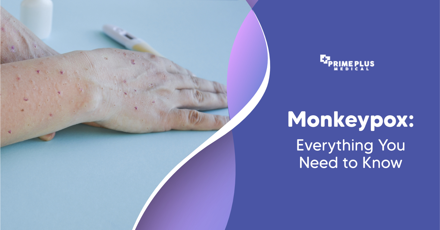 Monkeypox: What you need to know - UT Physicians